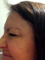 The Effects Of Your Botox Cosmetic Or Dysport Treatment