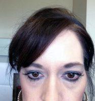 The Many Uses Of Botox Cosmetic