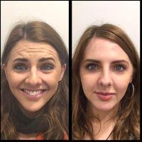 The Solution To Frown Lines, Crow's Fee