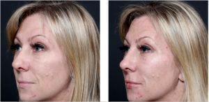 Volbella And Botox 11's Lines In The Glabella By Dr. Remus Repta, MD, Phoenix & Scottsdale Cosmetic Plastic Surgeon