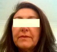 Wrinkle Treatment Has Been Revolutionized With Innovative BOTOX