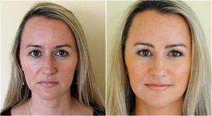 Xeomin In Glabella Region , Radiesse In Nasolabial Folds By Dr. Avron Lipschitz, MD, Palm Beach Gardens, FL Plastic Surgeon