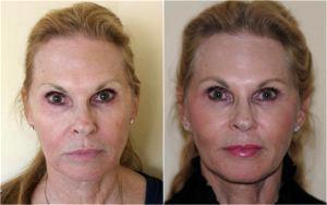 Xeomin Radiesse (2 Syringes) To Malar And Nasolabial Folds By Dr. Avron Lipschitz, MD, Palm Beach Gardens, FL Plastic Surgeon