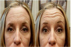 -and-2-weeks-Dysport-injection-by-Michele-Hunter-RN,Scottsdale,-AZ-_01