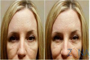 -and-2-weeks-Dysport-injection-by-Michele-Hunter-RN,Scottsdale,-AZ-_02