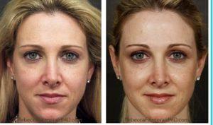 3 Vials Sculptra, Juvederm, Botox By Dr. Rebecca Fitzgerald,M.D.,Beverly Hills