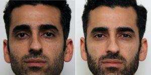 39 Year Old Man Treated With Botox By Dr. Nima Shemirani, MD, Beverly Hills Facial Plastic Surgeon