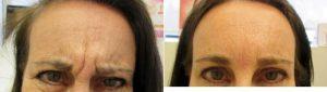 48 Year Old Woman Treated With Botox With Dr Benjamin Barankin, MD, FRCPC, Toronto Dermatologic Surgeon