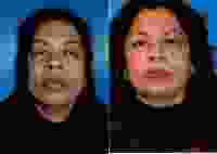 64 Year Old Woman Treated With Botox By Dr. E. John Serrao, MD, Orlando OB-GYN