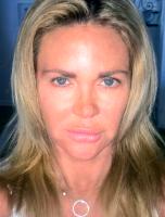 Affordable Botox Toronto