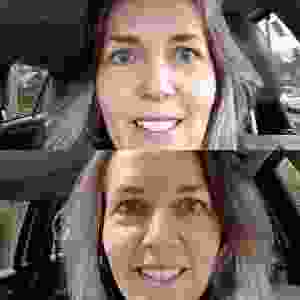 After Treatment One Of Sculptra And Dysport For The 11's And Forehead By Dr. Jennifer Reichel MD, Seattle