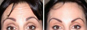 BOTOX-BEFORE-AFTER-DM-01-DUAL