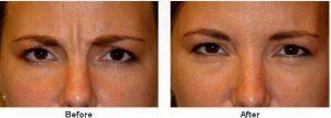 BOTOX Cosmetic Before & After By Stella Desyatnikova, M.D.,Seattle