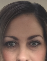 BOTOX Cosmetic In Baltimore, MD