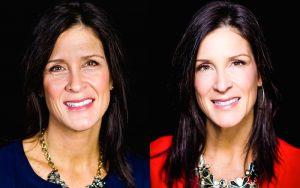 Before And After Dysport Treatment By Dr. Michele Shermak, MD,Baltimore