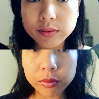 Best Botox Beverly Hills