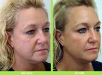 Best Orlando Botox By Doctor Armando Soto, Orlando Plastic Surgeon