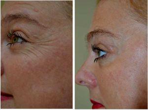 Botox 17th Street Fort Lauderdale