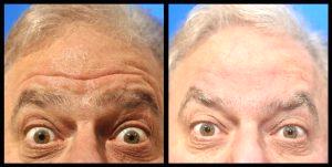 Botox And Filler By Dean P. Kane, MD, FACS,Baltimore