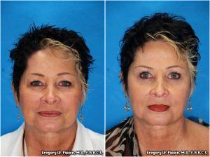 Botox And Juvederm Treatments By Gregory W. Pippin, M.D., F.A.A.C.S.,New Orleans