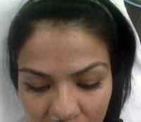 Botox Basically Prevents The Nerves There From Allowing Signals To Get Through