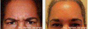 Botox Before And After By Dr. Parker Velargo, New Orleans