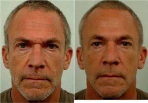 Botox Between The Eyebrows And Across The Forehead By Doctor Justin Yovino, MD, FACS, Beverly Hills Plastic Surgeon