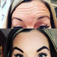 Botox By Doctor William Andrade, Toronto Plastic Surgeon