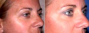 Botox By Dr. Shahram Salemy, MD, FACS, Seattle Plastic Surgeon