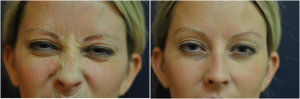 Botox By Jennifer Reichel, MD,Seattle