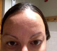 Botox Cosmetic Beverly Hills