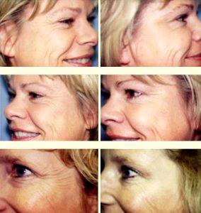Botox Cosmetic By Dr. David Pratt,Seattle