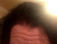 Botox Deals Beverly Hills