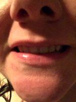 Botox Dysport And Xeomin Are Made Up Of Botulinum Toxin A