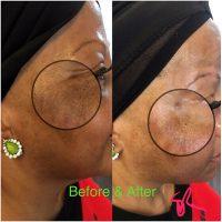 Botox Dysport And Xeomin Soften Or Erase Crows Feet