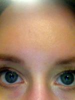 Botox Dysport And Xeomin Treatments Are Safe Quick Require No Recovery Time