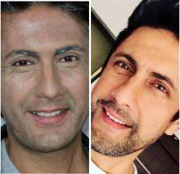 Botox Facial Injections By Dr. Edward J. Gross, Orlando Plastic Surgeon