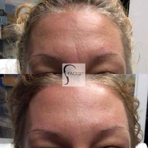 Botox Forehead In Toronto Before And After (1)