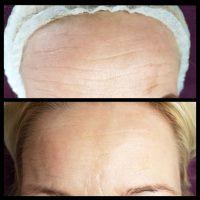 Botox Forehead Toronto