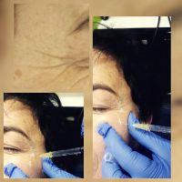 Botox Has Minimal Side Effects