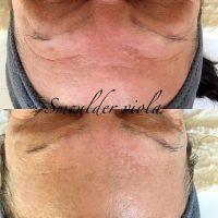 Botox Has Vast Cosmetic Possibilities