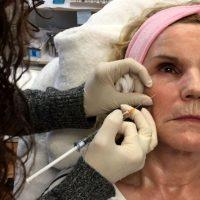 Botox In Fort Lauderdale Florida