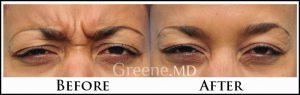 Botox Injection ByRyan Greene, MD, PhD, FACS, Fort Lauderdale