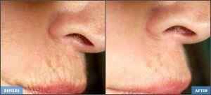 Botox Injections By Francis R Palmer III, M.D., F.A.C.S.,Beverly Hills