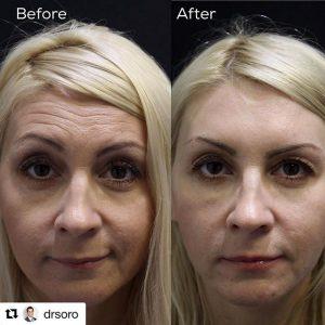 Botox Injections Forehead Wrinkles By Dr. Shino Bay Aguilera, Fort Lauderdale