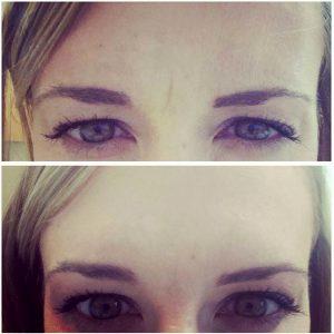 Botox Injections Paralyze Facial Muscles And Magically Erase Fine Lines And Deep Set Wrinkles By Dr. Wells,MD,Baltimore