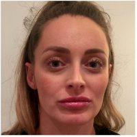 Botox Is Carefully And Skillfully Injected Into The Facial Muscles