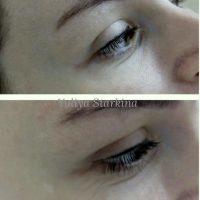 Botox Is Used Most Often On Areas Of The Face