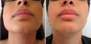 Botox - Masseter Reduction With Doctor Asif Pirani, MD, FRCS(C), Toronto Plastic Surgeon