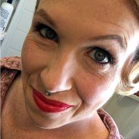 Botox Plastic Surgery With Dr. Dean P. Kane, Baltimore Plastic Surgeon